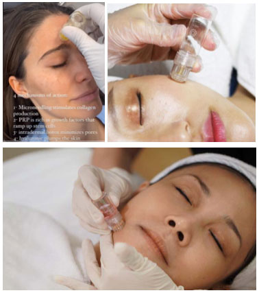 Women receiving the angel face botox treatment.