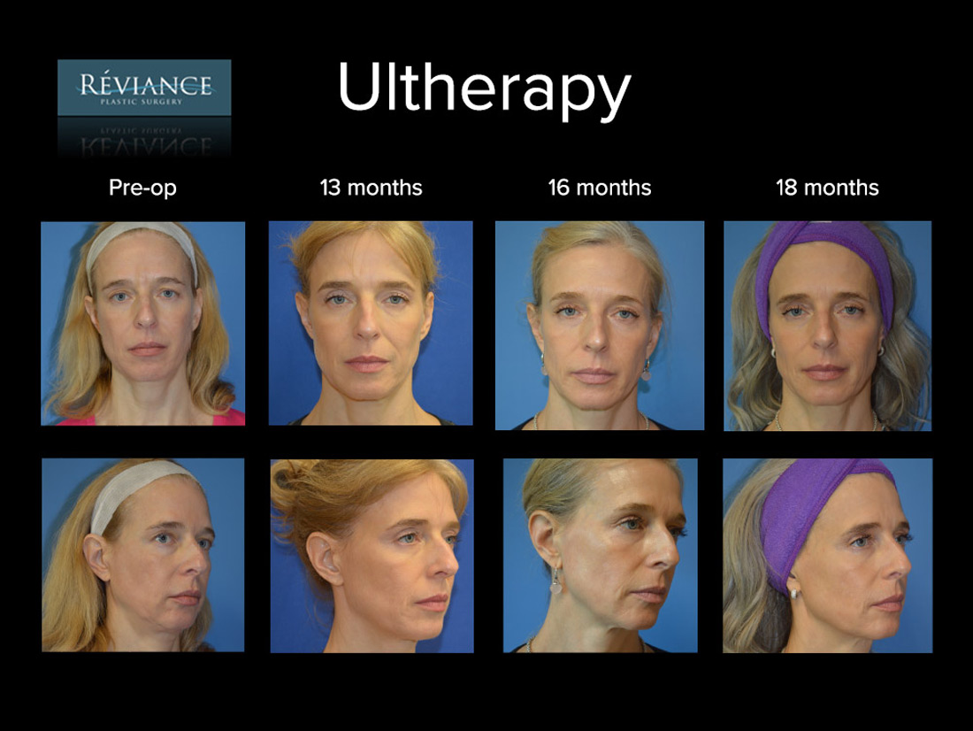 Ultherapy treatment results before and after 18 months