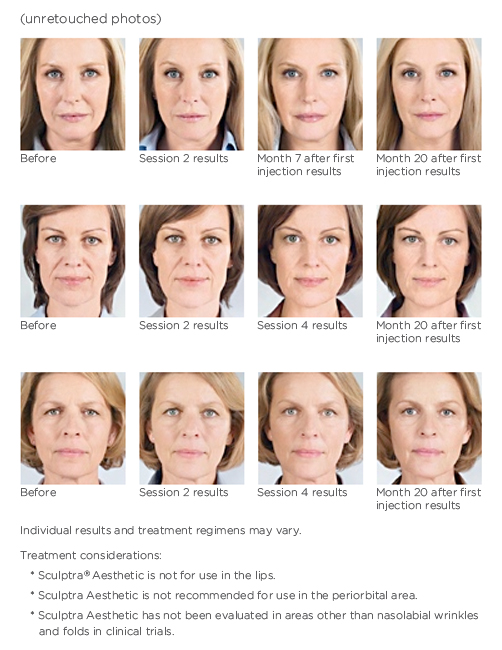 A graphic of three patients before and after Sculptra Aesthetic treatments. Each patient is show before treatment, after 2 sessions, after 4 sessions, and 20 months after the first initial session.